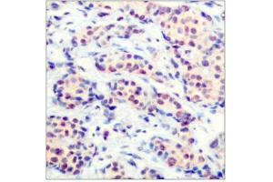 Immunohistochemical analysis of paraffin-embedded human breast carcinoma tissue using JunD(Ab-255) Antibody (JunD 抗体)
