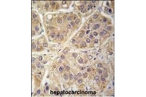 Formalin-fixed and paraffin-embedded human hepatocarcinoma tissue reacted with SARS2 antibody (Center) (ABIN392301 and ABIN2841955) , which was peroxidase-conjugated to the secondary antibody, followed by DAB staining. (SARS2 抗体  (AA 315-344))