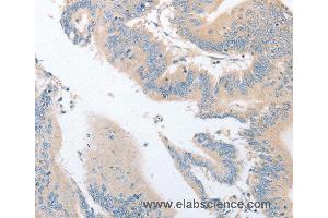 Immunohistochemistry of Human colon cancer using EPS15L1 Polyclonal Antibody at dilution of 1:30 (EPS15L1 抗体)