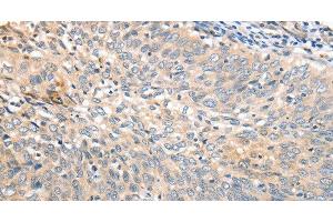 Immunohistochemistry of paraffin-embedded Human cervical cancer tissue using APTX Polyclonal Antibody at dilution 1:50 (Aprataxin 抗体)