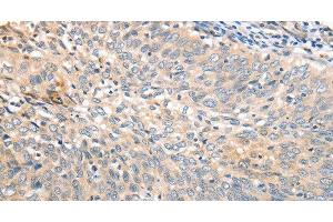 Immunohistochemistry of paraffin-embedded Human cervical cancer tissue using APTX Polyclonal Antibody at dilution 1:50 (Aprataxin 抗体)