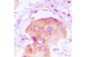 Immunohistochemical analysis of EPS8L2 staining in human lung cancer formalin fixed paraffin embedded tissue section. (EPS8-Like 2 抗体  (N-Term))