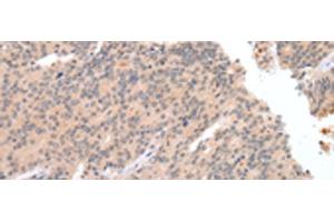 Immunohistochemistry of paraffin-embedded Human prost at e cancer tissue using DEFB112 Polyclonal Antibody at dilution of 1:40(x200) (DEFB112 抗体)