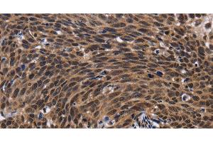 Immunohistochemistry of paraffin-embedded Human cervical cancer tissue using FASTKD5 Polyclonal Antibody at dilution 1:40 (FASTKD5 抗体)