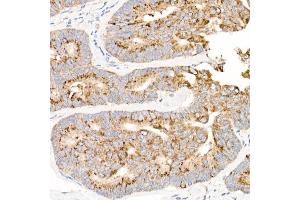 Immunohistochemistry of paraffin-embedded human colon carcinoma using MT-ND2 Rabbit pAb (ABIN7268600) at dilution of 1:50 (40x lens).
