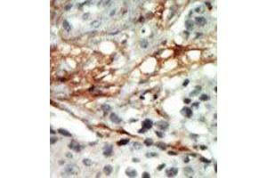 Formalin-fixed and paraffin-embedded human cancer tissue reacted with the primary antibody, which was peroxidase-conjugated to the secondary antibody, followed by AEC staining. (PRKAB2 抗体  (N-Term))