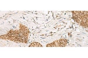 Immunohistochemistry of paraffin-embedded Human esophagus cancer tissue using PSPC1 Polyclonal Antibody at dilution of 1:30(x200) (PSPC1 抗体)