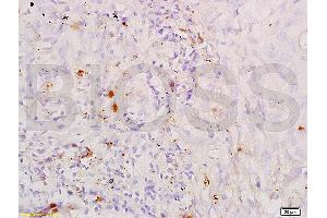 Formalin-fixed and paraffin embedded human lung carcinoma labeled with Anti-SP-D PSPD Polyclonal Antibody, unconjugated (ABIN731678) at 1:200, followed by incubation with conjugated secondary antibody and DAB staining. (SFTPD 抗体  (AA 301-375))