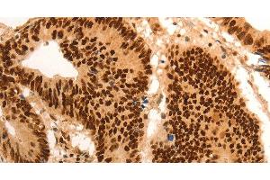 Immunohistochemistry of paraffin-embedded Human colon cancer tissue using E2F7 Polyclonal Antibody at dilution 1:60 (E2F7 抗体)