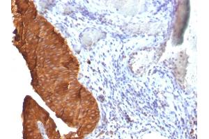 Formalin-fixed, paraffin-embedded human Bladder Carcinoma stained with Cytokeratin 19 Monoclonal Antibody (SPM561) (Cytokeratin 19 抗体)