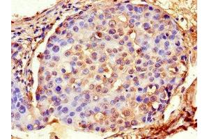 Immunohistochemistry of paraffin-embedded human breast cancer using ABIN7143140 at dilution of 1:100 (Actin, gamma 1 抗体  (AA 13-166))