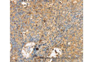 Immunohistochemistry of Human lung cancer using MAPK6 Polyclonal Antibody at dilution of 1:40 (MAPK6 抗体)