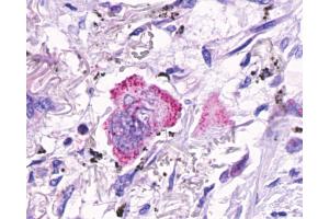 Anti-GPR48 / LGR4 antibody IHC of human Lung, Adenocarcinoma. (LGR4 抗体  (C-Term))