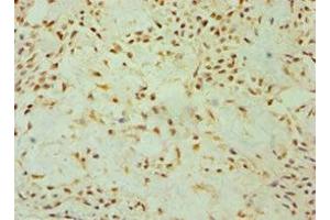 Immunohistochemistry of paraffin-embedded human breast cancer using ABIN7149891 at dilution of 1:100 (DKK4 抗体  (AA 19-224))