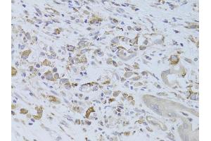 Immunohistochemistry of paraffin-embedded human breast cancer using IGF2 Antibody (ABIN6292141) at dilution of 1:100 (40x lens). (IGF2 抗体)