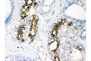 Anti-SOD2 Picoband antibody, IHC(P) IHC(P): Human Mammary Cancer Tissue (SOD2 抗体  (C-Term))