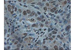 Immunohistochemical staining of paraffin-embedded Carcinoma of liver using anti-ID2 (ABIN2452680) mouse monoclonal antibody. (Id2 抗体)