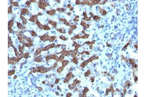 Formalin-fixed, paraffin-embedded human Hepatocellular Ca stained with CPS1 Monoclonal Antibody (CPS1/1022). (CPS1 抗体)