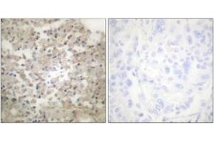 Immunohistochemistry analysis of paraffin-embedded human lung carcinoma, using Tryptophan Hydroxylase (Phospho-Ser260) Antibody. (Tryptophan Hydroxylase 1 抗体  (pSer260))