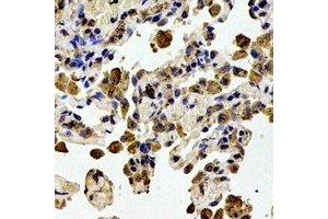 Immunohistochemical analysis of STMN1 (pS38) staining in human lung cancer formalin fixed paraffin embedded tissue section. (Stathmin 1 抗体  (N-Term, pSer38))