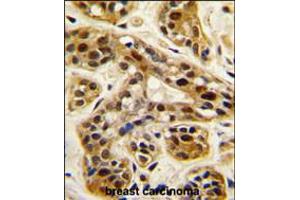 Formalin-fixed and paraffin-embedded human breast carcinoma tissue reacted with , which was peroxidase-conjugated to the secondary antibody, followed by DAB staining. (PRMT1 抗体  (C-Term))