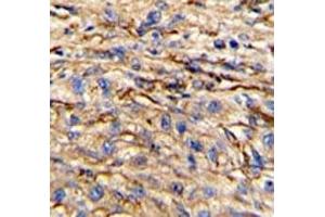 IHC analysis of FFPE human hepatocarcinoma stained with Nestin antibody (Nestin 抗体  (AA 1389-1416))