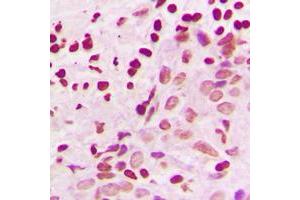 Immunohistochemical analysis of MKK3/6 staining in human breast cancer formalin fixed paraffin embedded tissue section. (MKK3/6 (Center) 抗体)