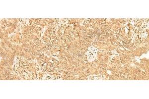 Immunohistochemistry of paraffin-embedded Human ovarian cancer tissue using ST8SIA4 Polyclonal Antibody at dilution of 1:50(x200) (ST8SIA4 抗体)