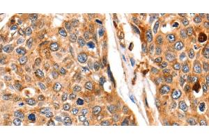 Immunohistochemistry of paraffin-embedded Human esophagus cancer tissue using Cathepsin B Polyclonal Antibody at dilution 1:140 (Cathepsin B 抗体)