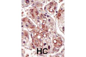 Formalin-fixed and paraffin-embedded human hepatocellular carcinoma tissue reacted with MAP2K2 polyclonal antibody  , which was peroxidase-conjugated to the secondary antibody, followed by DAB staining. (MEK2 抗体  (AA 262-292))