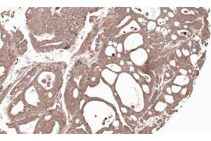IHC-P Image Immunohistochemical analysis of paraffin-embedded Gastric CA N87 xenograft, using MMP12, antibody at 1:100 dilution. (MMP12 抗体)