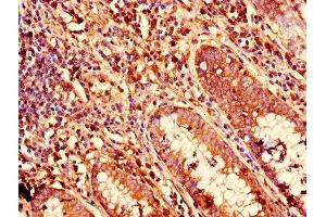 Immunohistochemistry of paraffin-embedded human colon cancer using ABIN7157408 at dilution of 1:100 (KRT81 抗体  (AA 3-505))