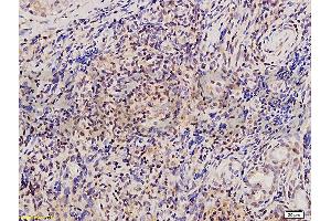 Formalin-fixed and paraffin embedded human osteosarcoma tissue labeled with Anti-Twist Polyclonal Antibody , and DAB staining (TWIST1, TWIST2 (AA 71-170) 抗体)
