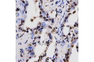 Immunohistochemistry of paraffin-embedded human lung cancer tissue using H3K4me2 antibody at dilution of 1:200 (x400 lens). (Histone 3 抗体  (H3K4me2))