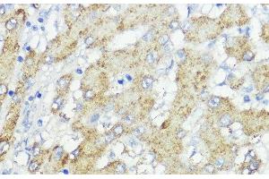 Immunohistochemistry of paraffin-embedded Human liver cancer using SOCS6 Polyclonal Antibody at dilution of 1:100 (40x lens). (SOCS6 抗体)