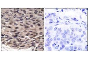 Immunohistochemical analysis of paraffin-embedded human breast carcinoma tissue using FKHRL1 (phospho-Ser253) antibody (E011222). (eIF4EBP1 抗体  (pThr36))