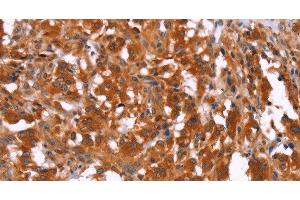 Immunohistochemistry of paraffin-embedded Human thyroid cancer using HAS1 Polyclonal Antibody at dilution of 1:30 (HAS1 抗体)
