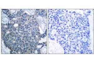 Immunohistochemical analysis of paraffin-embedded human breast carcinoma tissue using Stathmin 1 (Ab-24) antibody (E021217). (Stathmin 1 抗体)