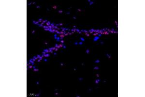 Immunofluorescence of paraffin embedded human breast cancer using CITED4 (ABIN7073356) at dilution of 1:2200 (400x lens) (CITED4 抗体)