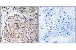 Immunohistochemistry analysis of paraffin-embedded human breast carcinoma tissue, using GPR116 Antibody.