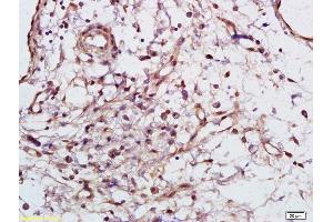 Formalin-fixed and paraffin embedded human gastric carcinoma labeled with Rabbit Anti Phospho-Syk (Tyr525/526) Polyclonal Antibody, Unconjugated (ABIN746273) at 1:200 followed by conjugation to the secondary antibody and DAB staining