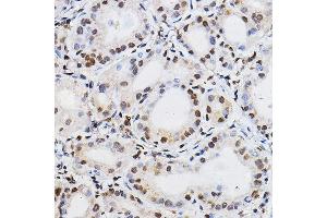 Immunohistochemistry of paraffin-embedded human thyroid cancer using PER2 Rabbit pAb (ABIN6131889, ABIN6145450, ABIN6145452 and ABIN6217063) at dilution of 1:100 (40x lens). (PER2 抗体  (AA 1-150))