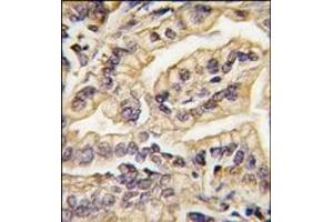 Formalin-fixed and paraffin-embedded human lung carcinoma tissue reacted with CSF1R Antibody (C-term), which was peroxidase-conjugated to the secondary antibody, followed by DAB staining. (CSF1R 抗体  (C-Term))