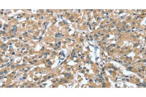 Immunohistochemistry of paraffin-embedded Human thyroid cancer tissue using DTX1 Polyclonal Antibody at dilution 1:30 (Deltex Homolog 1 抗体)