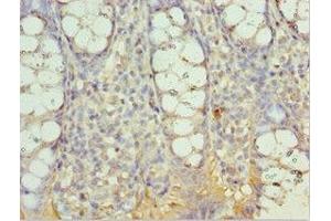 Immunohistochemistry of paraffin-embedded human colon cancer using ABIN7143999 at dilution of 1:100 (AIMP2 抗体  (AA 141-320))