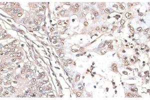 Immunohistochemistry of paraffin-embedded Human endometrium cancer using MEF2C Polyclonal Antibody at dilution of 1:100 (40x lens). (MEF2C 抗体)