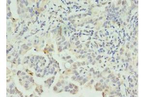 Immunohistochemistry of paraffin-embedded human lung cancer using ABIN7146041 at dilution of 1:100 (CLEC1A 抗体  (AA 74-280))