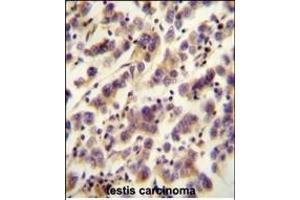 OR1J4 antibody (C-term) (ABIN655015 and ABIN2844648) immunohistochemistry analysis in formalin fixed and paraffin embedded human testis carcinoma followed by peroxidase conjugation of the secondary antibody and DAB staining.