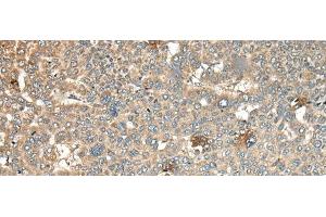 Immunohistochemistry of paraffin-embedded Human liver cancer tissue using CA11 Polyclonal Antibody at dilution of 1:45(x200) (CA11 抗体)