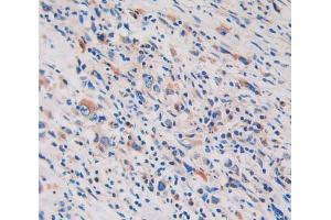 IHC-P analysis of stomach cancer tissue, with DAB staining. (GLDC 抗体  (AA 81-268))